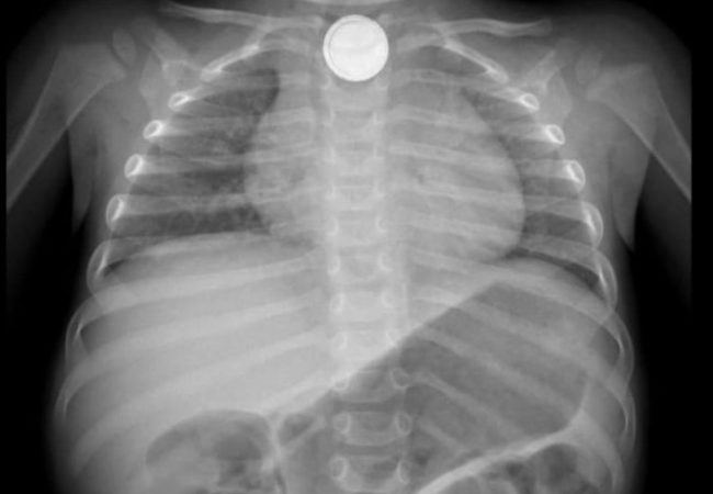 צילום הרנטגן שבו התגלתה הסוללה בוושט